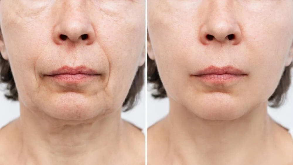 Facelift Surgery