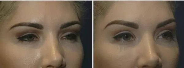 brow lift surgery