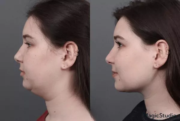 buccal fat removal