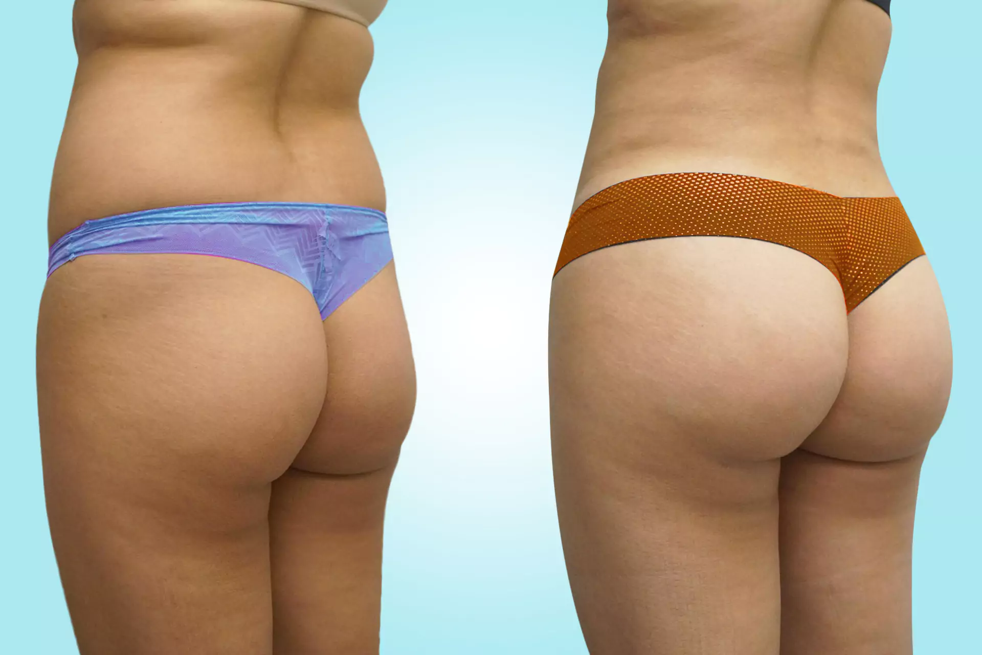 buttock augmentation