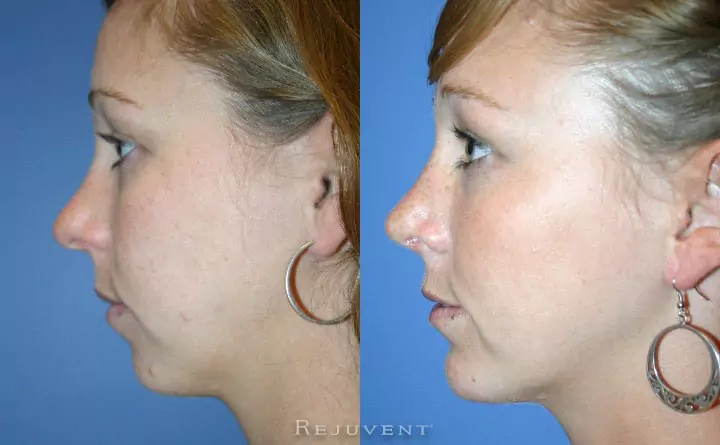 chin augmentation surgery