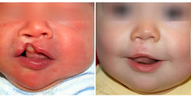 cleft clip palate surgery