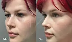 Eyelid Surgery