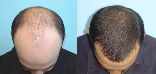 fue hair transplant