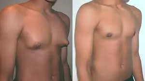 gynecomastia surgery