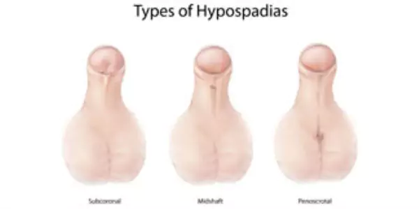 hypospadias