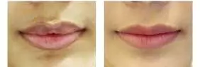 Lip Reduction Surgery