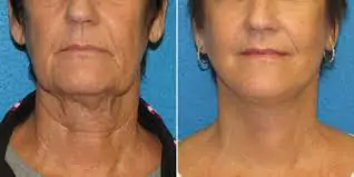 Neck Lift Surgery