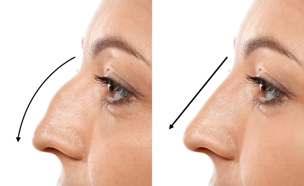 rhinoplasty