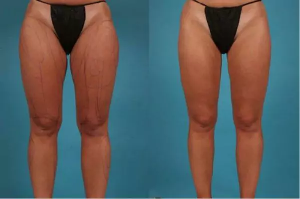 thigh lift surgery