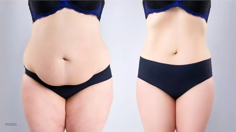 tummy tuck surgery